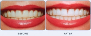 Teeth Bleaching